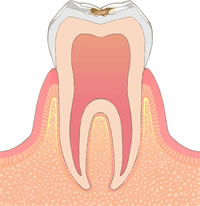 虫歯レベル1（C1）