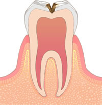 虫歯レベル2（C2）