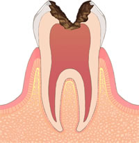 虫歯レベル3（C3）