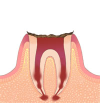 歯レベル4（C4）