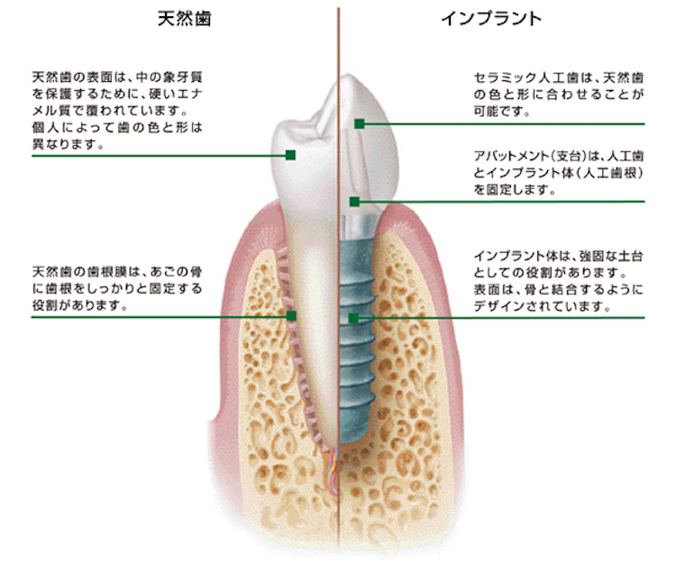 安全性の高いインプラント治療