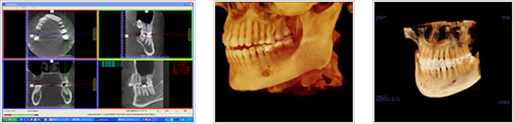 歯科用CTの導入