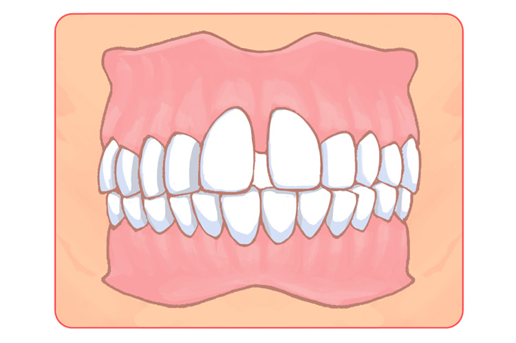 空隙歯列