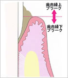 歯周病の原因と進行について