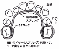 図Ａ　リンガルアーチ