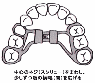 図Ｃ　拡大装置（固定式）ラッピットエキスバンジョン